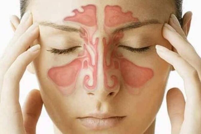Sinus Infection – Symptoms, Treatment, Causes